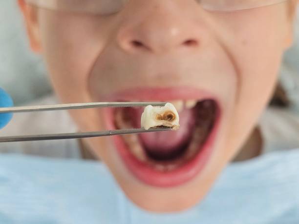 Best Emergency Dentist for Lost Fillings or Crowns in Hendersonville, TN