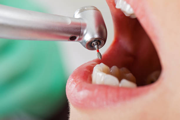 Best Broken or Cracked Tooth Emergency Dentist in Hendersonville, TN